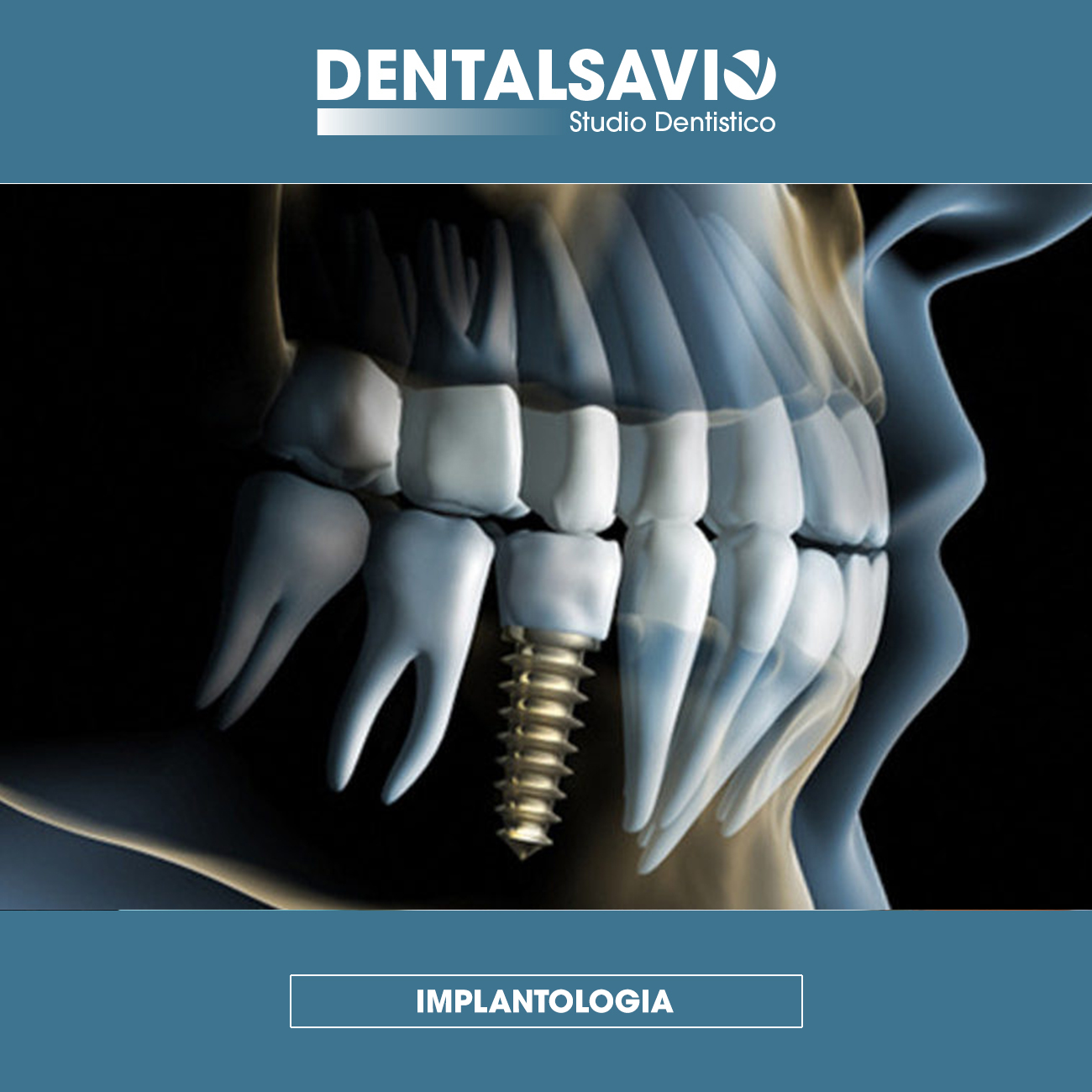 implantologia
