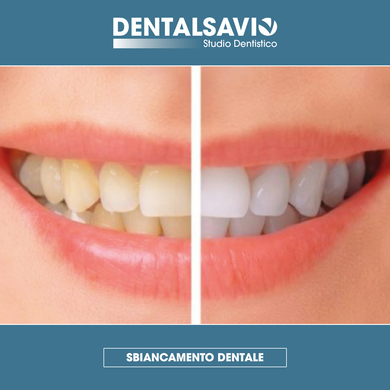 Sbiancamento dentale