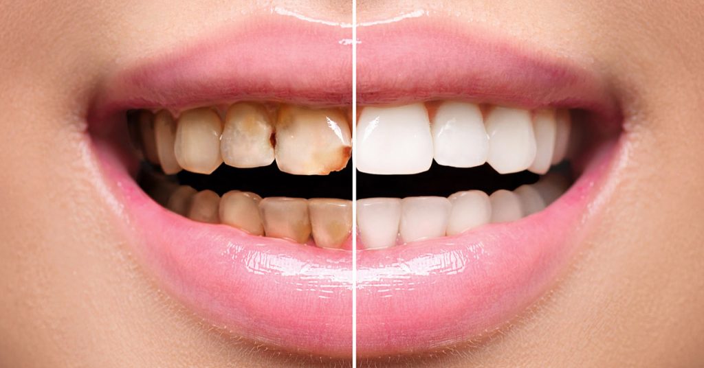 Le faccette dentali del Centro Odontoiatrico Pitino prima e dopo faccette dentali
