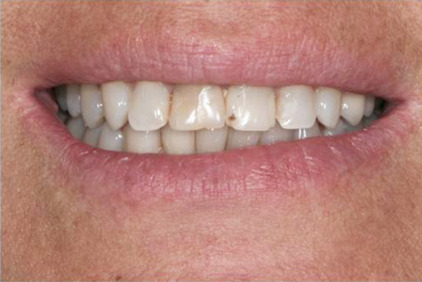 denti prima